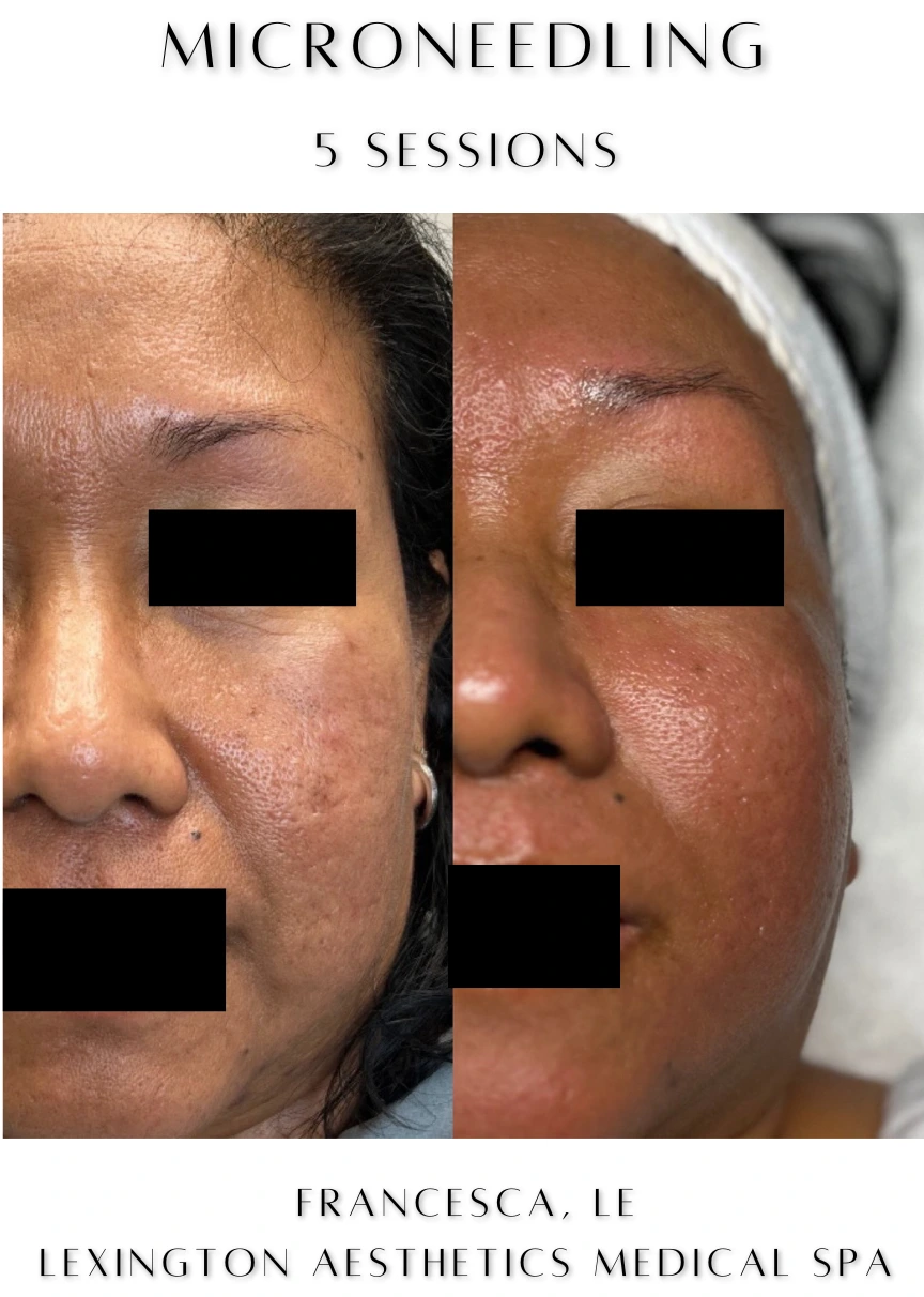 Microneedling