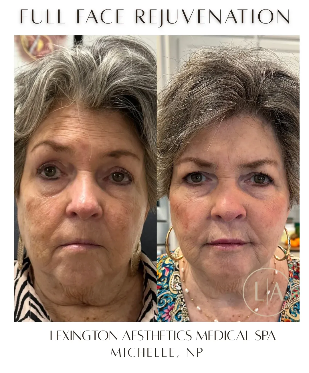 Dermal Filler (1)