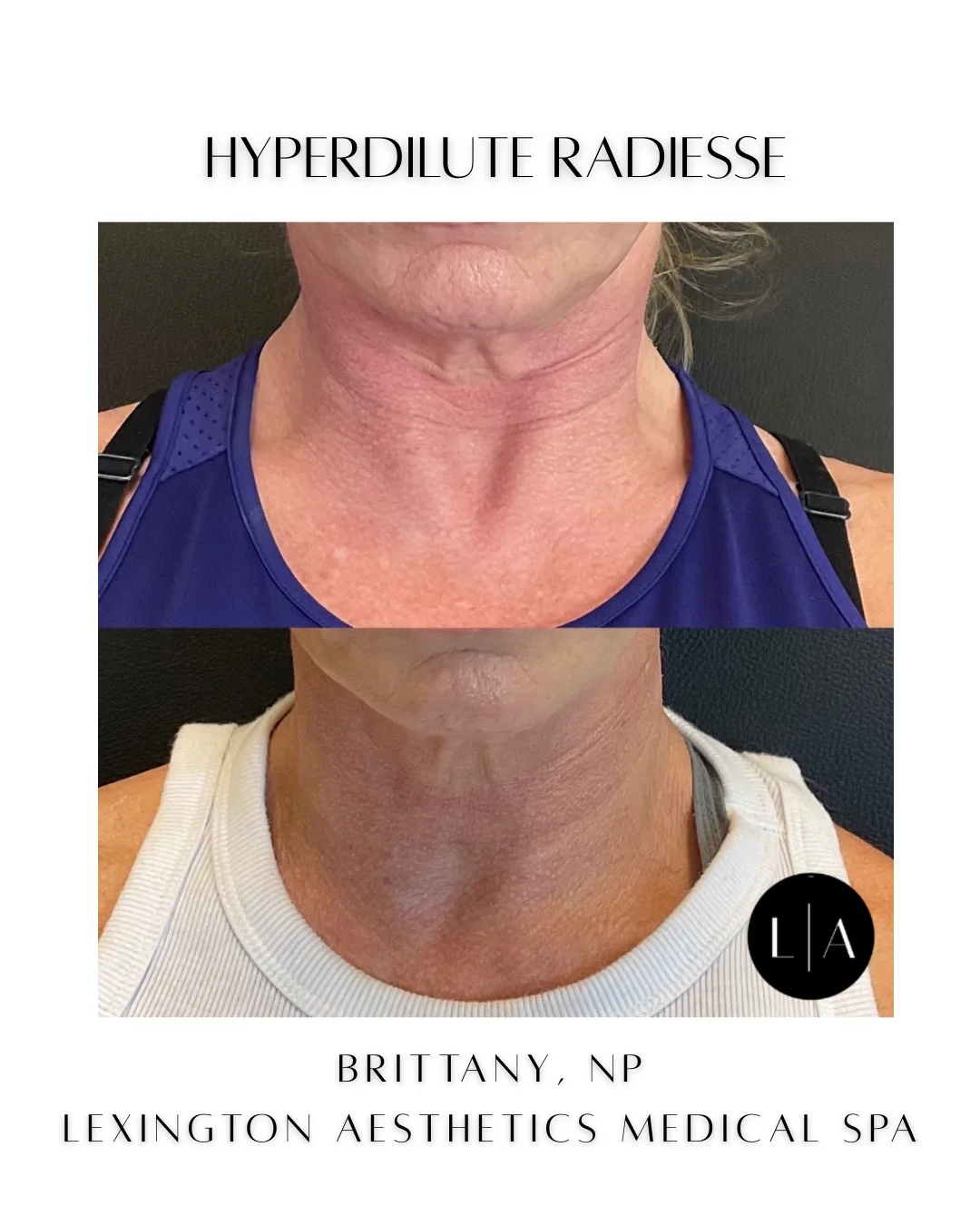 Hyperdilute Radiesse two