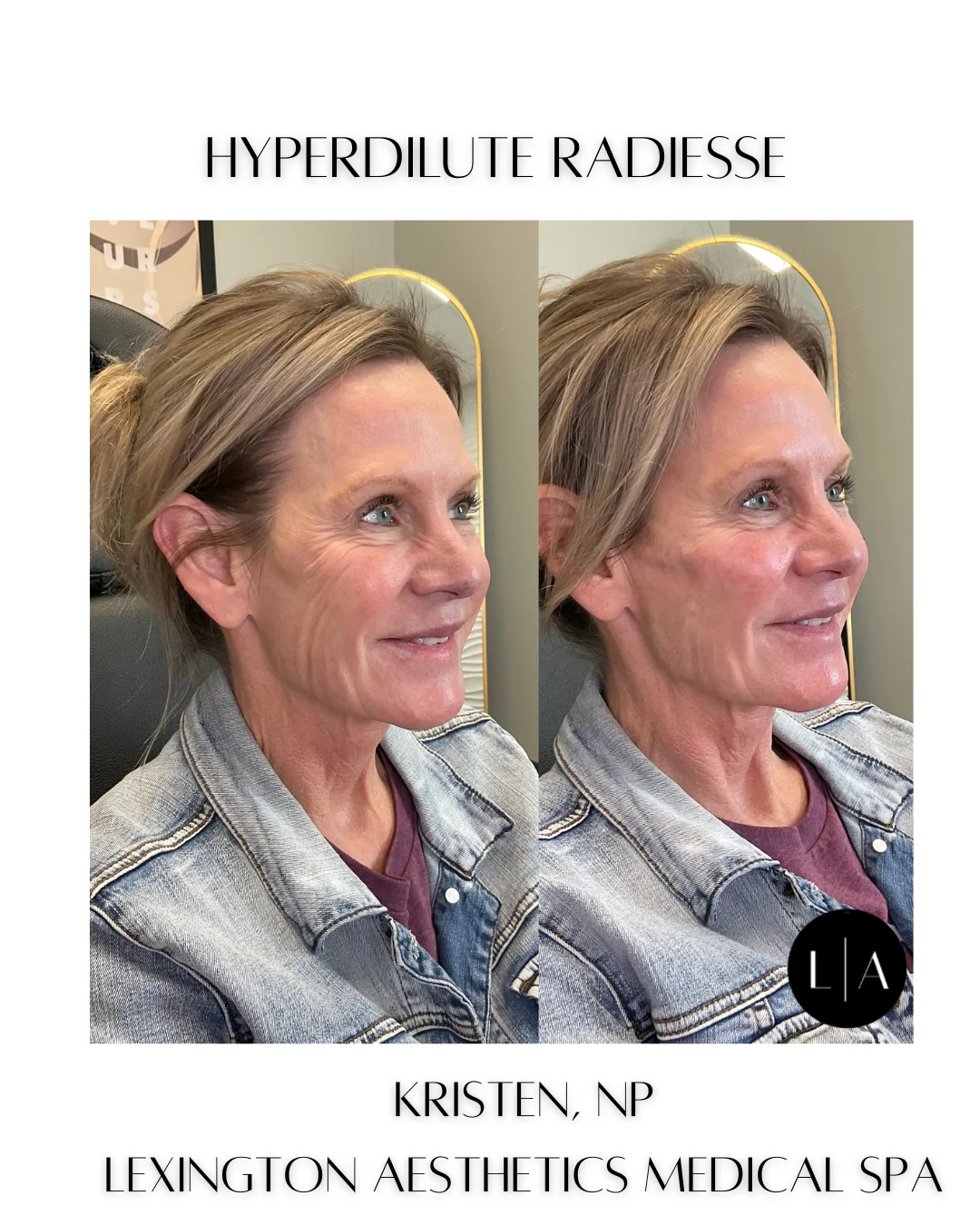 Hyperdilute Radiesse