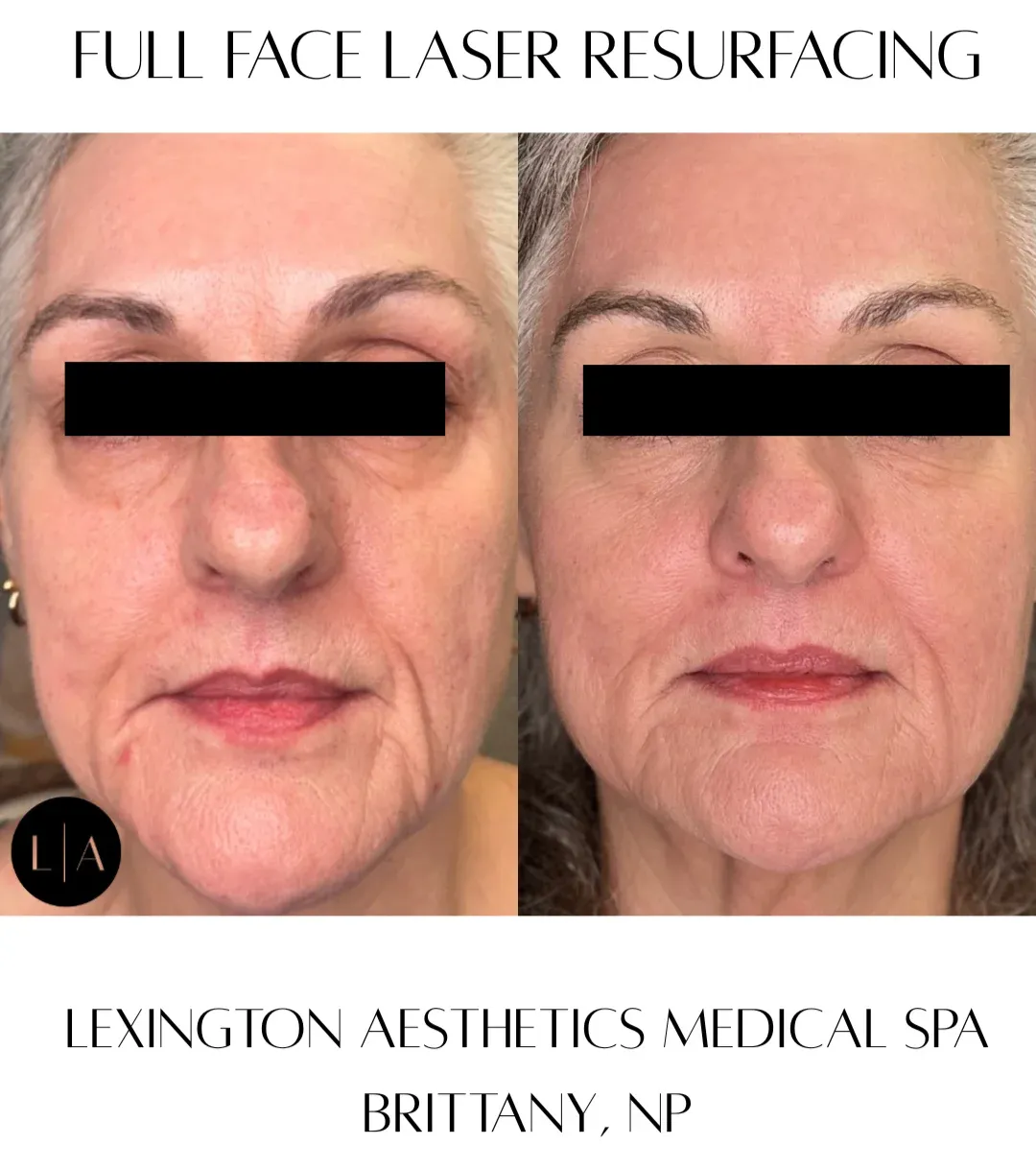 Laser Skincare Services (1)