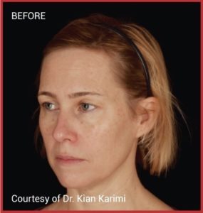 Lexaesthetics-Natural Growth Factor injections-BA1