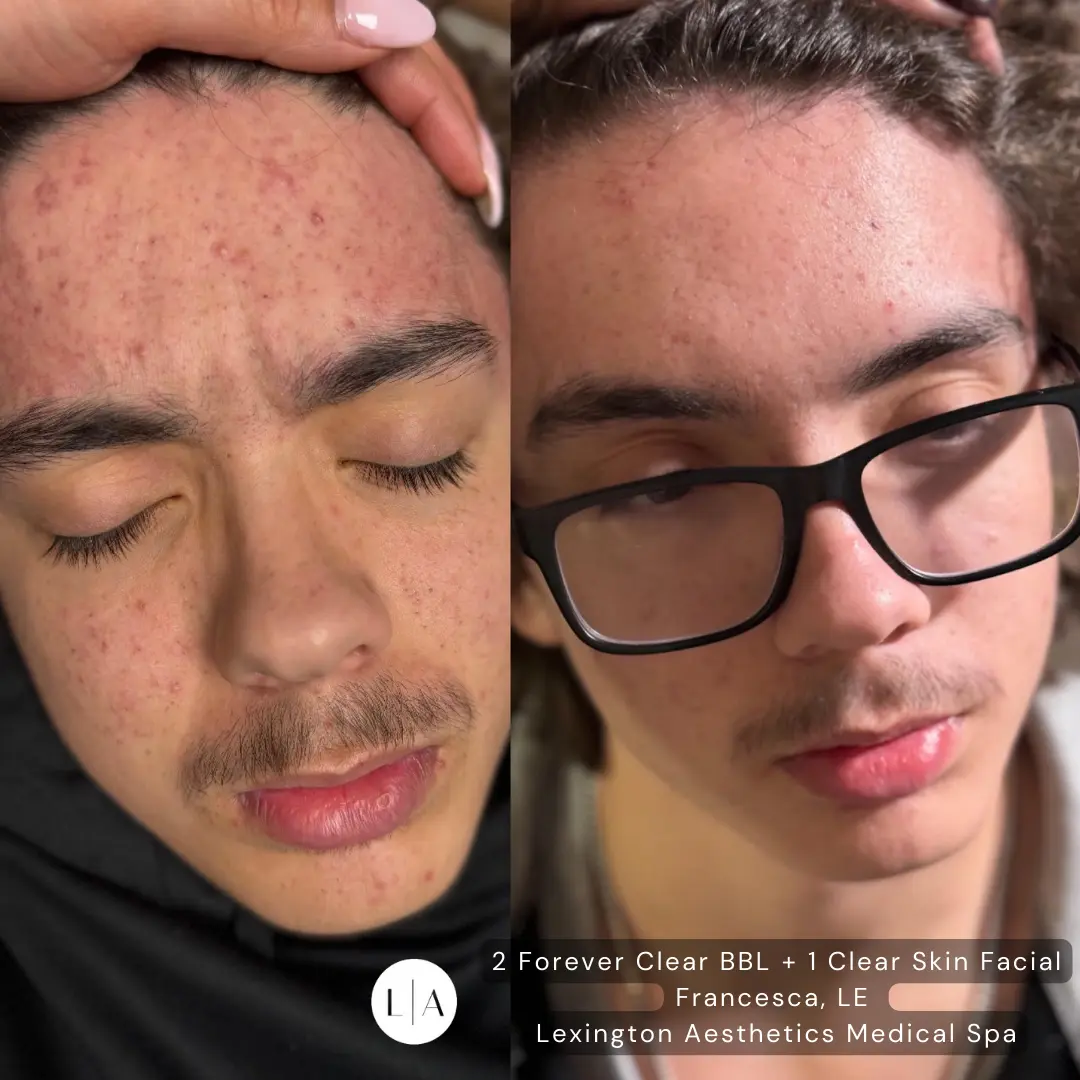 Acne-Beforeandafter1